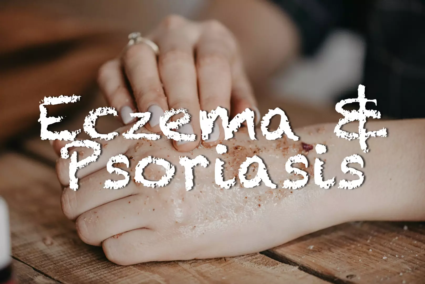 Eczéma et psoriasis : les crèmes ne suffisent pas